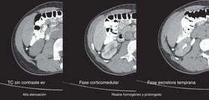 tomografia renal con contraste