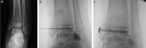Paciente de 12 años de edad con dolor en el tobillo izquierdo tras una caída de un caballo. (a) La radiografía de frente identifica una fractura Salter-Harris tipo IV de la tibia distal y Salter-Harris tipo I del peroné (fractura de Mc Farland) con desplazamiento superior a 2mm. (b) Se muestra la artrografía intraoperatoria luego de la reducción y (c) la fijación transitoria.