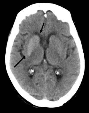 La tomografía computada sin contraste intravenoso muestra un aumento de la densidad del núcleo lenticular y de la cabeza del núcleo caudado (flechas), sin efecto de masa ni edema en el parénquima adyacente.