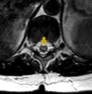 Resonancia magnética, en corte axial, con secuencia ponderada en T2 pone de manifiesto la lesión hiperintensa con la forma característica de los ojos de lechuza, signo sugestivo de infarto medular (flecha amarilla).