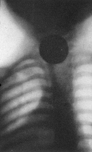 Primera radiografía de una moneda en la garganta.