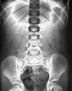Relieve-radiografía de abdomen.