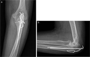 Rx del codo izquierdo: fractura de olécranon fijada con agujas Kirschner y alambres en incidencia (a) de frente y (b) de perfil.