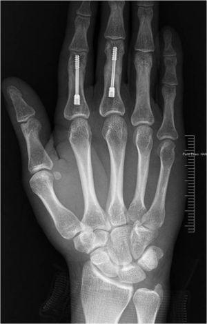 Rx de frente de la mano derecha con tornillos medulares, diseñados con rosca en ambos extremos (Herbert), en las falanges proximales del 2.° y el 3.er dedo.