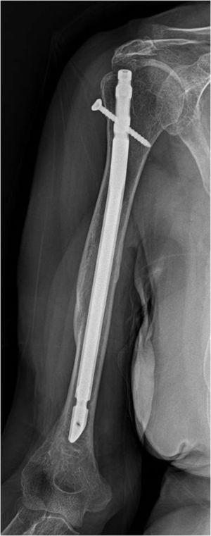 Rx de frente del brazo derecho con clavo intramedular rígido y bloqueo dinámico proximal (tornillo) por una fractura diafisaria desplazada del húmero.
