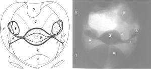 Anatomía radiológica normal: (1) cadera ósea; (2) partes musculares intrapelvianas que dan el límite del contorno interno endopleviano; (3) útero; (4) ligamento largo y parametrio (a) ligamento redondo, (b) trompa y (c) parametrio; (5) ovarios; (6) fondo de saco vesicouterino; (7) fosa retrouterina; (8) vejiga y (9) unión rectosigmoidea.