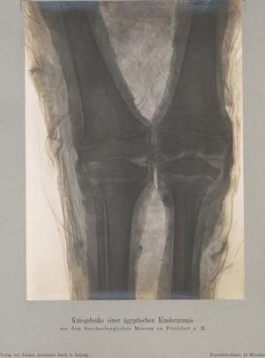 Imagen de rayos X realizada por W. Koenig en 1896.