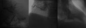 Coronariografia e ventriculografia esquerda. Oclusão da artéria descendente anterior. Coronária direita não dominante. Ventrículo esquerdo exibe acinesia anteroapical.