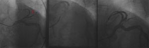 Intervenção coronária percutânea no segundo ramo da artéria descendente anterior (seta).