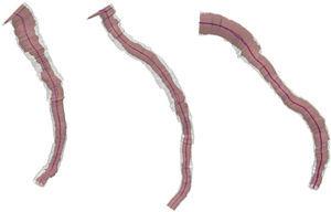 Da esquerda para direita, temos a reconstrução tridimensional da artéria descendente anterior (casos 1 e 2) e da artéria circunflexa, no caso 3. A luz e a membrana elástica externa estão representadas pelas linhas de centro vermelha e azul, e pelo preenchimento volumétrico rosa e branco, respectivamente.