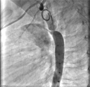 . Aortografia descendente em perfil esquerdo mostra coarctação focal ao final do istmo aórtico e, adicionalmente, a presença de um canal arterial do tipo A, opacificando o tronco pulmonar.