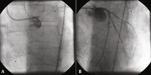 Trombose De Stent Em Tronco Da Coronária Esquerda | Revista Brasileira ...