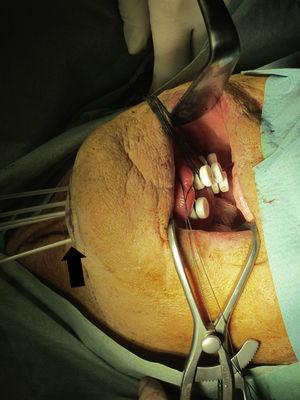 Colocación de agujas de braquiterapia en el remanente lingual. Su extremo distal emerge por la región submentoniana (flecha). Paciente del caso 1. Fuente: autores.