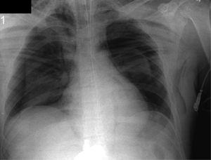 Radiografía de tórax con neumotórax espontáneo bilateral. Fuente: autores.