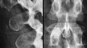 Radiografía simple de columna lumbar; se observa parte del catéter formando un asa. Fuente: autores.