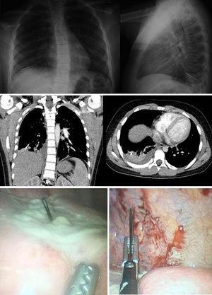 Radiografía y tomografía de tórax que demuestran cuerpo extraño metálico en localización basal derecha intraparenquimatosa. Visión toracoscópica de cuerpo extraño metálico en parénquima pulmonar y extracción con cirugía mínimamente invasiva.