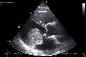 Ecocardiograma en eje largo paraesternal con la masa prolapsando en diástole hacia el ventrículo izquierdo, originando una obstrucción intermitente a nivel de la válvula mitral.