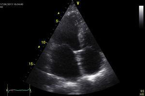 Ecocardiograma control (9 meses después), en 4 cámaras apical se aprecia la zona de extirpación del mixoma en el septum interauricular.