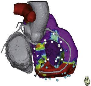 Imagen fusionada con tomografía computarizada en la que se muestra curso de otras estructuras cardiacas con la base del ventrículo derecho incluyendo las arterias coronarias. Tomada con permiso de Díaz et al.14.
