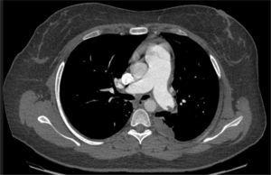 Tomografía axial computarizada en la que se observan trombos en las arterias pulmonares.