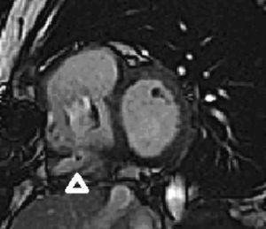 Eje corto, en la imagen de resonancia magnética cardíaca Equipo 1,5. Tesla, la punta de flecha señala una imagen con realce tardío del contraste en la región infero-basal del ventrículo derecho que se correlaciona con el área de bajo voltaje < 0,5V núcleo de la cicatriz en el mapa electroanatómico 3D del sistema Ensite.
