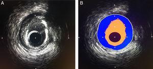 A. Representació imagenológica de la paret vascular mitjançant IVUS, B. Representació esquemàtica de la paret vascular; àrea luminal color groc, íntima (punts grocs), mitja representada per línia blanca, àrea blava correspon a àrea d'ateroma.