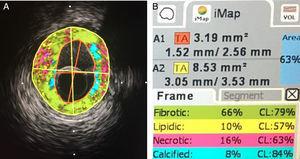 histologia virtual. À esquerda, corte artéria com avaliação de composição de placas. À direita: porcentagem de cada componente.