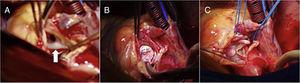 Procedimiento quirúrgico de cierre del aneurisma del seno de Valsalva en septum. En A se observa la boca del aneurisma que es el piso del seno del Valsalva no coronariano roto hacia el septum interventricular. En B se realiza el cierre del saco del aneurisma con parche de dacrón y en C se aprecia montaje de la prótesis aórtica biológica.