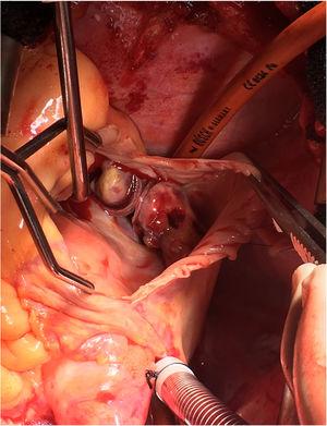 Imagen intraoperatoria de las dos masas auriculares derechas en la válvula de Eustaquio.