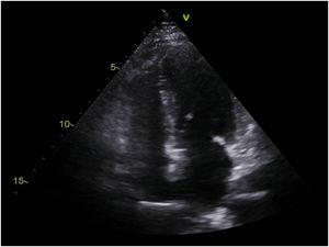 Ecocardiograma transtorácico. Ventrículo izquierdo no dilatado ni hipertrofiado. Ausencia de valvulopatías significativas.