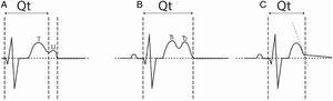 Medición del QT. A. En presencia de onda U. B. En caso de onda T bífida. C. En caso de compensación del electrocardiógrafo.