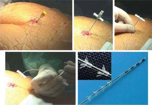 Imagens tiradas de: Michele spinelli, Karl-Dietrich Sievert. Últimos desenvolvimentos tecnológicos e cirúrgicos no uso da terapia interstim para a neuromodulação sacral: impacto no sucesso do tratamento e segurança. Urologia europeia. 2008; 54: 1287-96.