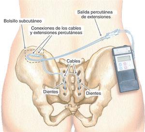 Primera fase (font: Medtronic Inc.).