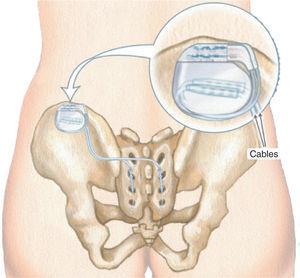 Segona fase (font: Medtronic Inc).