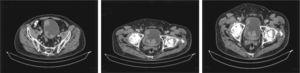 Cortes axiales en TAC abdominal y pélvico en donde se encuentran lesiones multifocales de aspecto tumoral en piso, pared anterior, posterior y lateral derecha de la vejiga
