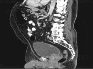 Reconstrucción sagital de TAC abdominal y pélvico que muestra la presencia de lesiones de aspecto tumoral hacia el piso, y cara posterior de la vejiga, con extensión hacia el cuello vesical y uretra.