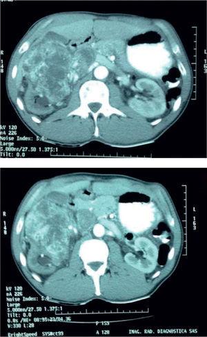 Cortes axiales en tomografía computarizada abdominal simple y contrastada.