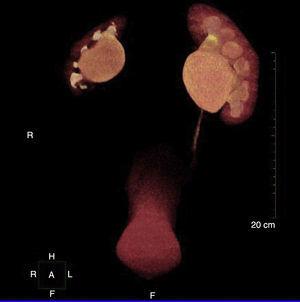 Imagen en tercera dimensión de urografía por TAC multicorte.