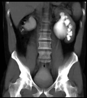 Imagen de urografía excretora por TAC.