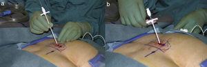 Izquierda: paso del introductor a través de la incisión ampliada. Derecha: retirada del coaxial. Tomada de: Chai34.