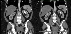 Tomografía axial de abdomen con contraste en cortes coronales que muestra cálculo coraliforme incompleto ocupando cáliz superior y medio en riñón izquierdo.