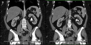 Tomografía axial de abdomen con contraste en cortes coronales que muestra cálculo coraliforme incompleto ocupando pelvis renal en riñón izquierdo.