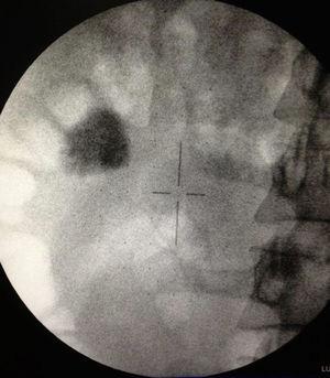 Visión fluoroscópica de riñón derecho con evidencia de cálculo coraliforme incompleto>2cm.