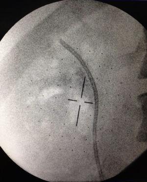 Visión Fluoroscópica de riñón derecho posterior a NRFL en donde se aprecia la ausencia de fragmentos residuales significativos posterior a un solo tiempo quirúrgico.