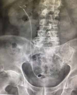 Radiografía de abdomen simple con catéter doble j en posición en uréter derecho, sin evidencia de litos residuales en silueta renal o trayecto ureteral posterior a un único tiempo quirúrgico.