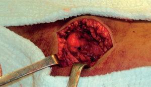 Se realiza lavado articular; se pasa broca de 2,5mm en la parte medial de la patela y luego, mediante túneles óseos, se reinsertan el retináculo medial y el ligamento patelofemoral medial.