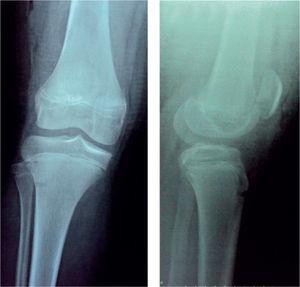 Radiografías posquirúrgicas sin luxación residual y con la patela centrada.