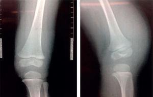 A los rayos X no se evidencian lesiones que indiquen enfermedad tumoral ósea, fracturas o signos de luxación articular.