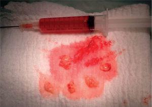 El reporte de cirugía informa de retiro de material hematoseroso abundante (aproximadamente 100ml) con membranas. Muestras de la sinovial engrosada.