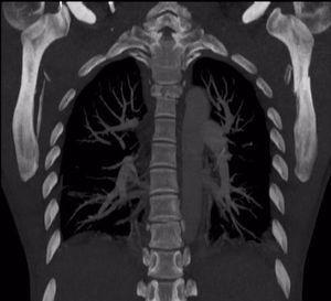 Corte coronal de angiografía por tomografía computarizada de tórax en que se observan fracturas de cuerpos vertebrales en T3 y T4.